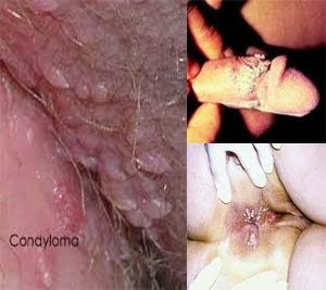 Illustration for article titled Harga Obat Kutil Kelamin